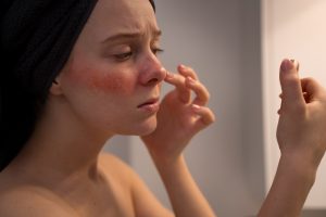 Búcsúzz el az állandó arcpírtól, válassz minőségi rosacea krémet! Arcpír